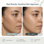 Before-and-after skincare comparison showing a woman's cheek and jawline for sensitive skin, with text reading 'Real Results. Sensitive Skin Approved.